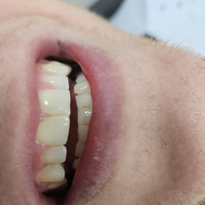 שיניים חשופות בפה פתוח בבדיקה דנטלית