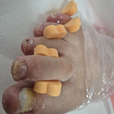 טיפול פדיקור עם מפרידי אצבעות כתומים