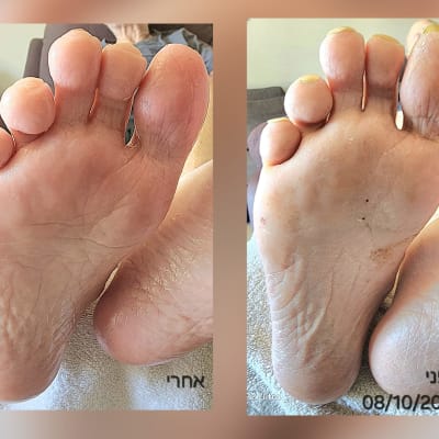 תמונות של כפות רגליים לפני ואחרי טיפול יופי