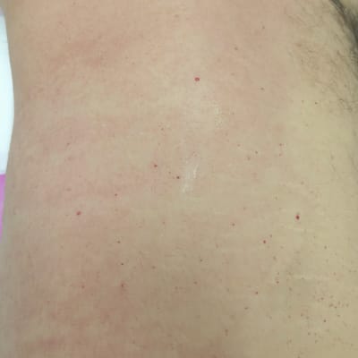 עור עם סימנים אדומים, טיפול קוסמטי אפשרי