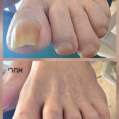 תמונות לפני ואחרי טיפול פדיקור