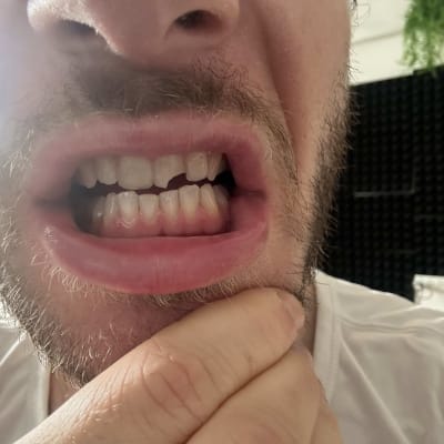 תקריב של שיניים חשופות בפה פתוח