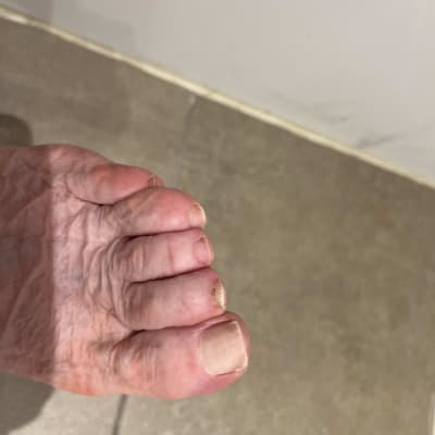 תקריב של כף רגל עם ציפורניים לא מטופלות