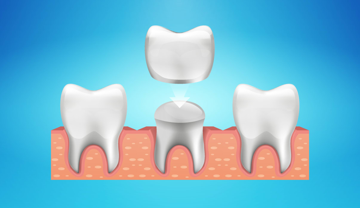 כתר לשיניים כתר לשיניים
