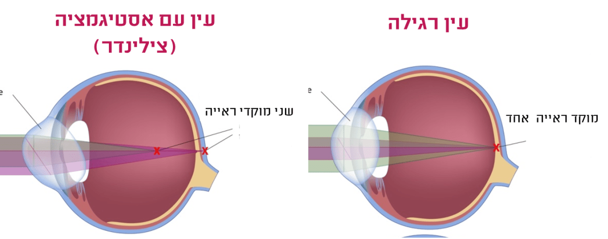 עין רגילה לעומת עין עם צילינדר עין רגילה לעומת עין עם צילינדר