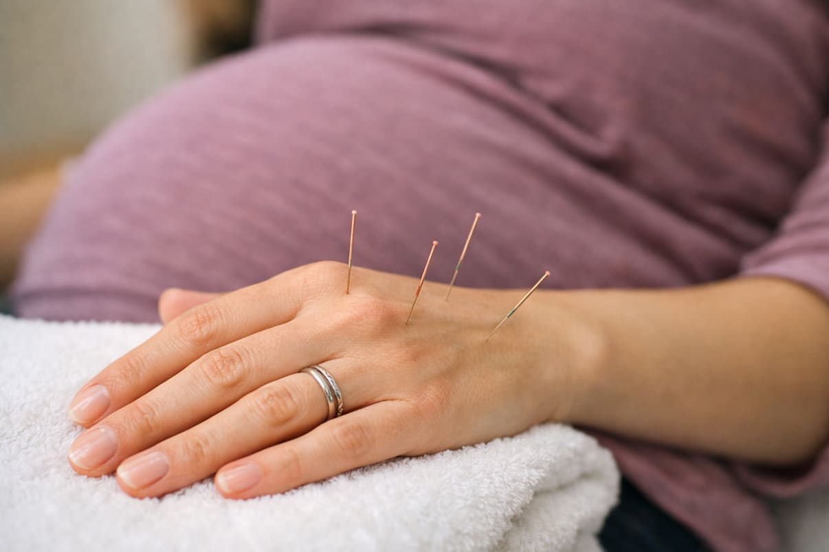 דיקור סיני לאישה בהריון