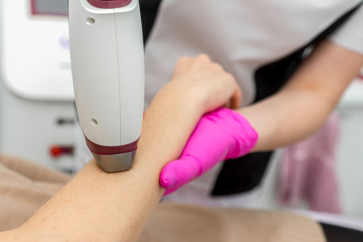 טיפול הסרת שיער באינפרא אדום 