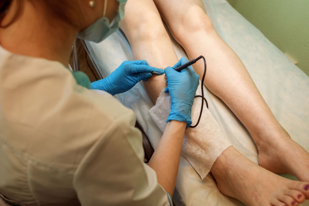 טיפול אפילציה 