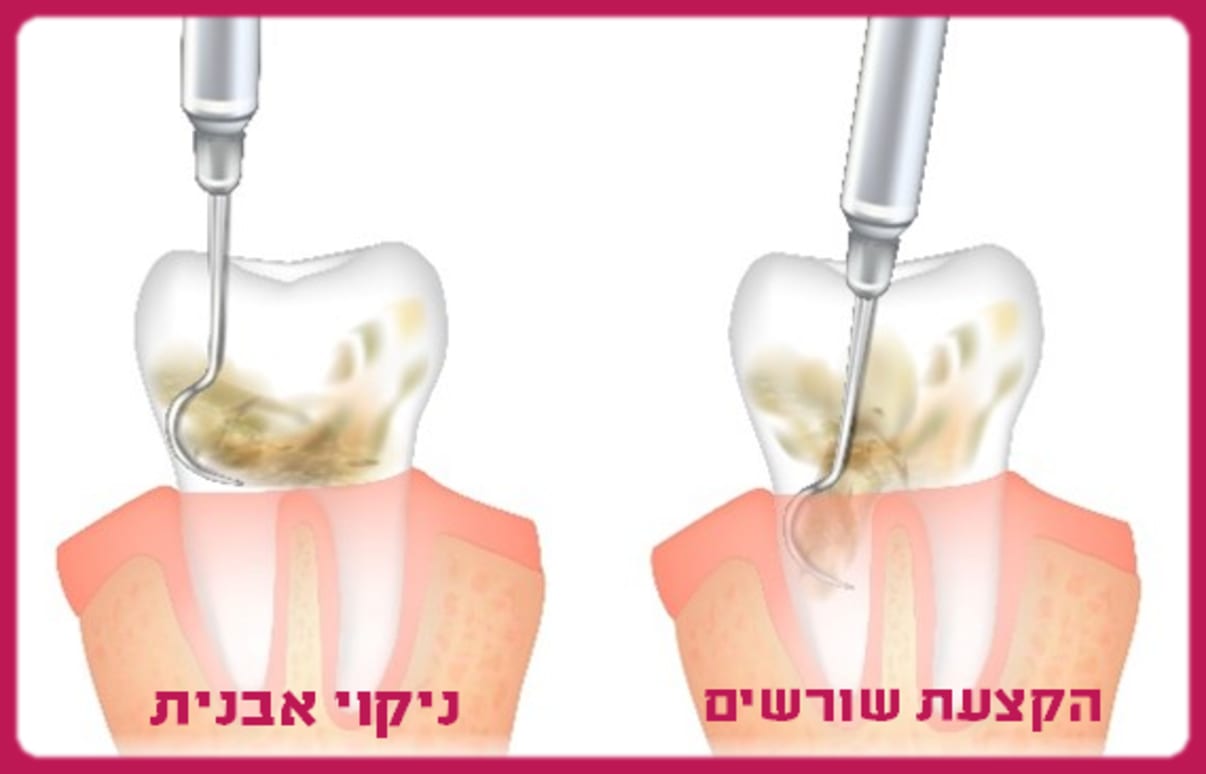 הקצעת שורשים או ניקוי אבנית רגיל הקצעת שורשים או ניקוי אבנית רגיל