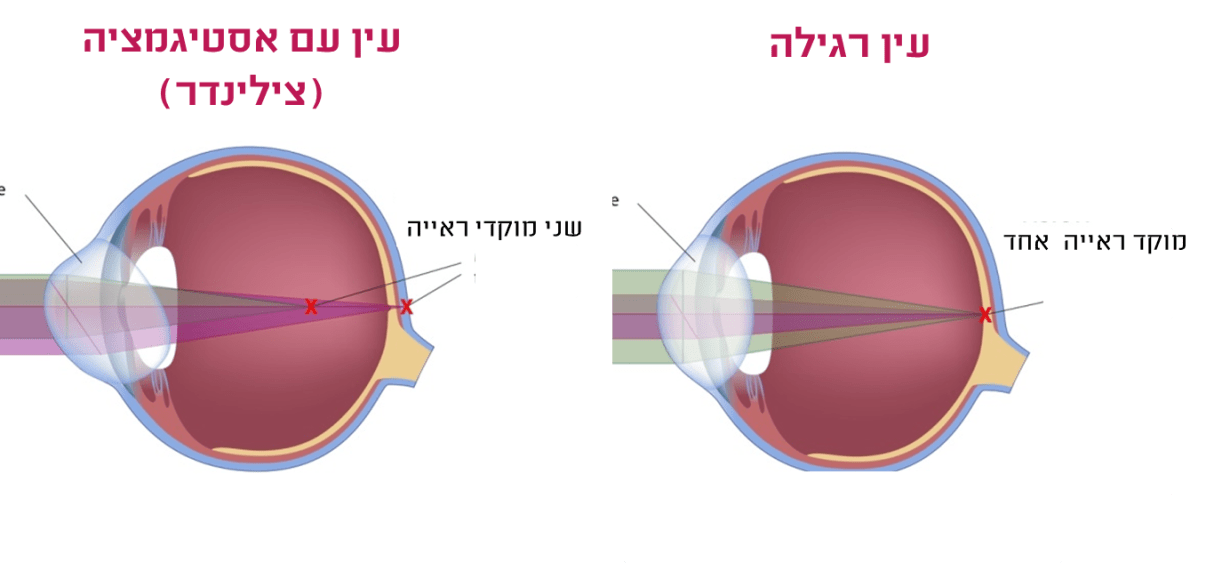 עין רגילה לעומת עין עם צילינדר