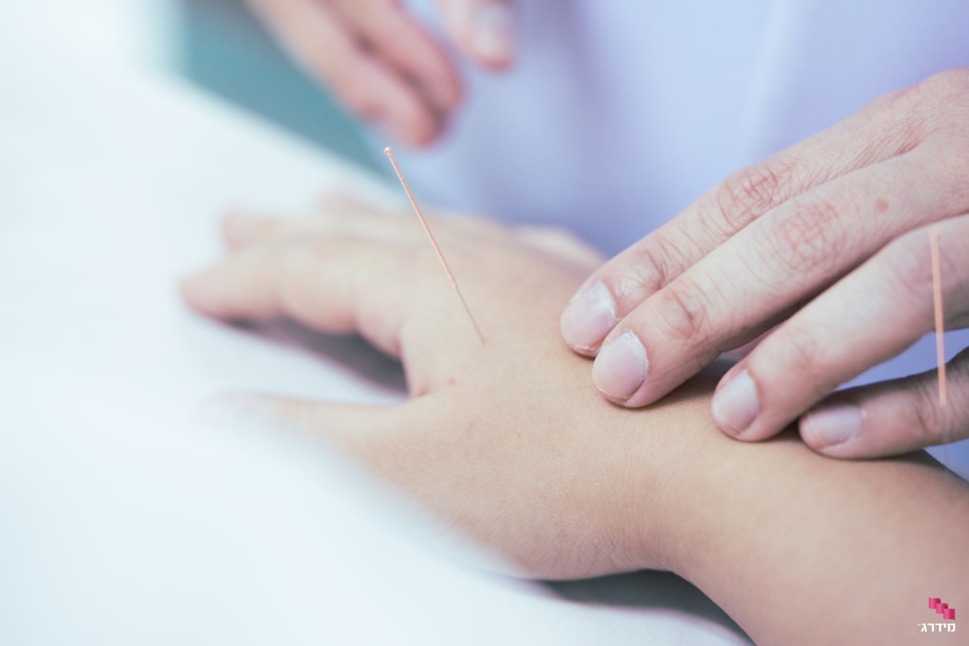 דיקור סיני בנקודת דיקור ביד