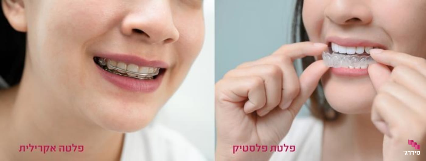 סוגי פלטות סוגי פלטות