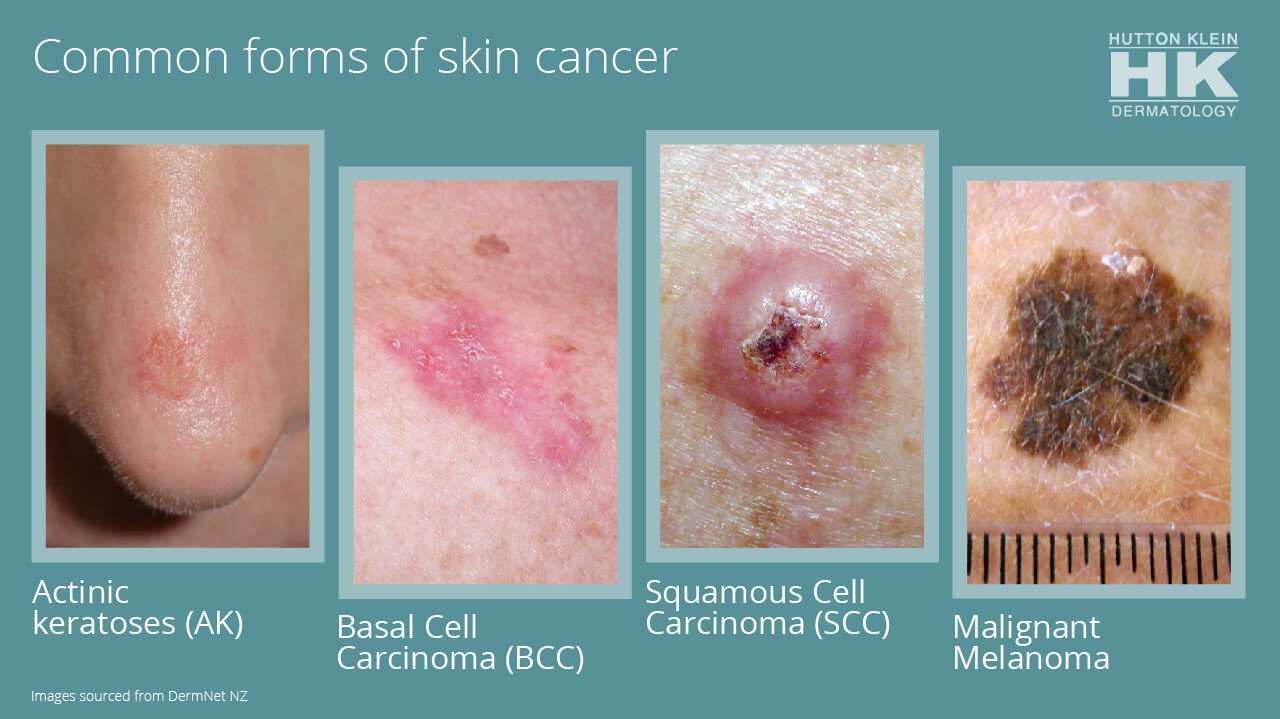 skin cancer types squamous cell carcinoma