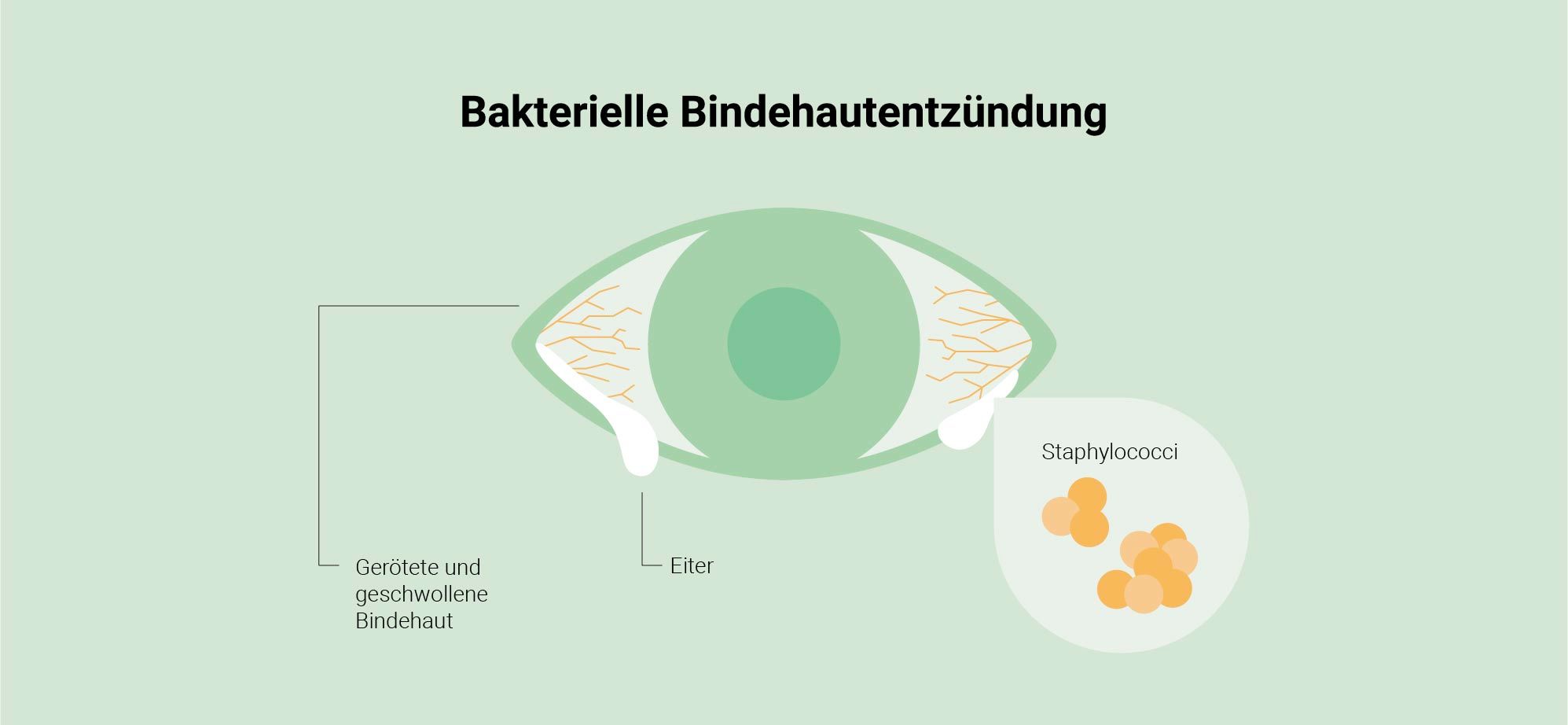 Bindehautentzündung