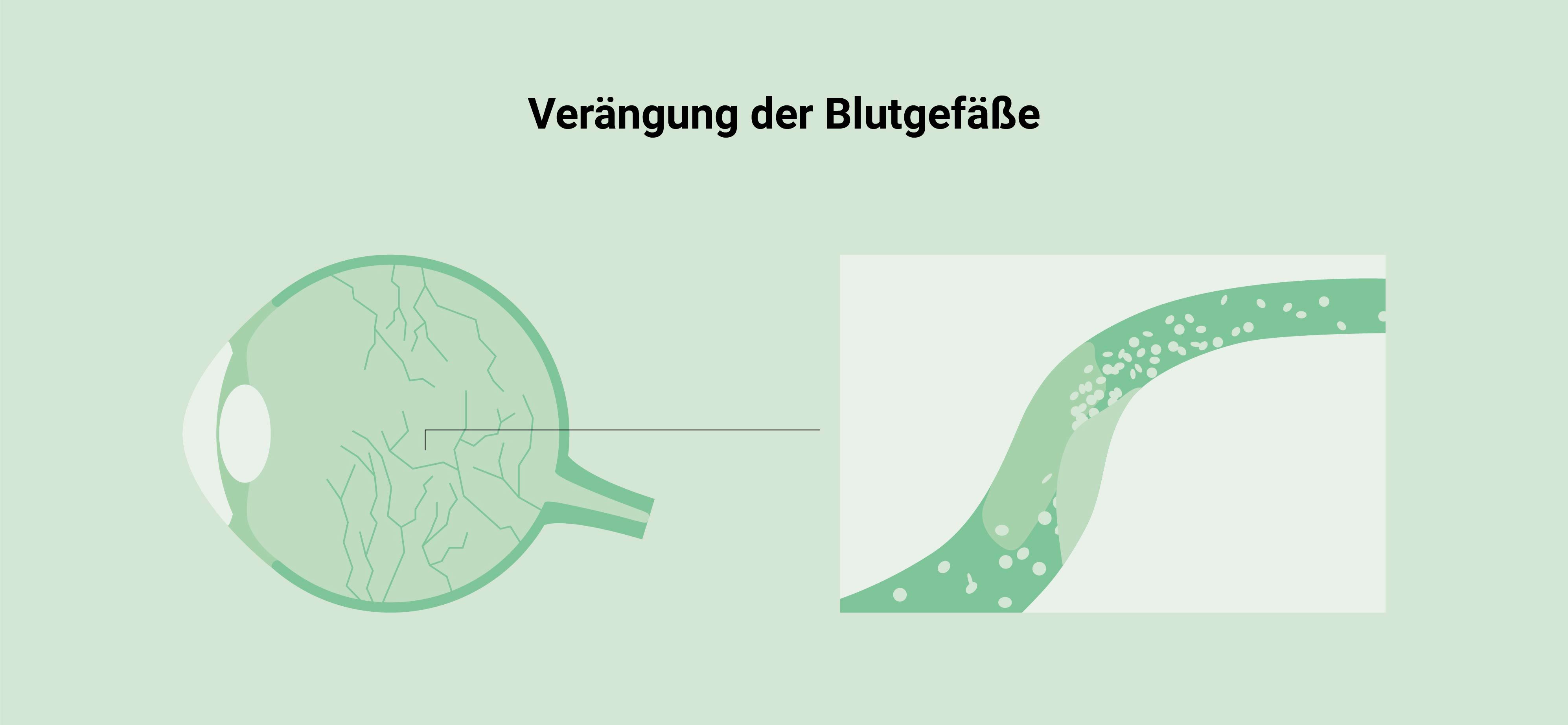 Augeninfarkt Ursache