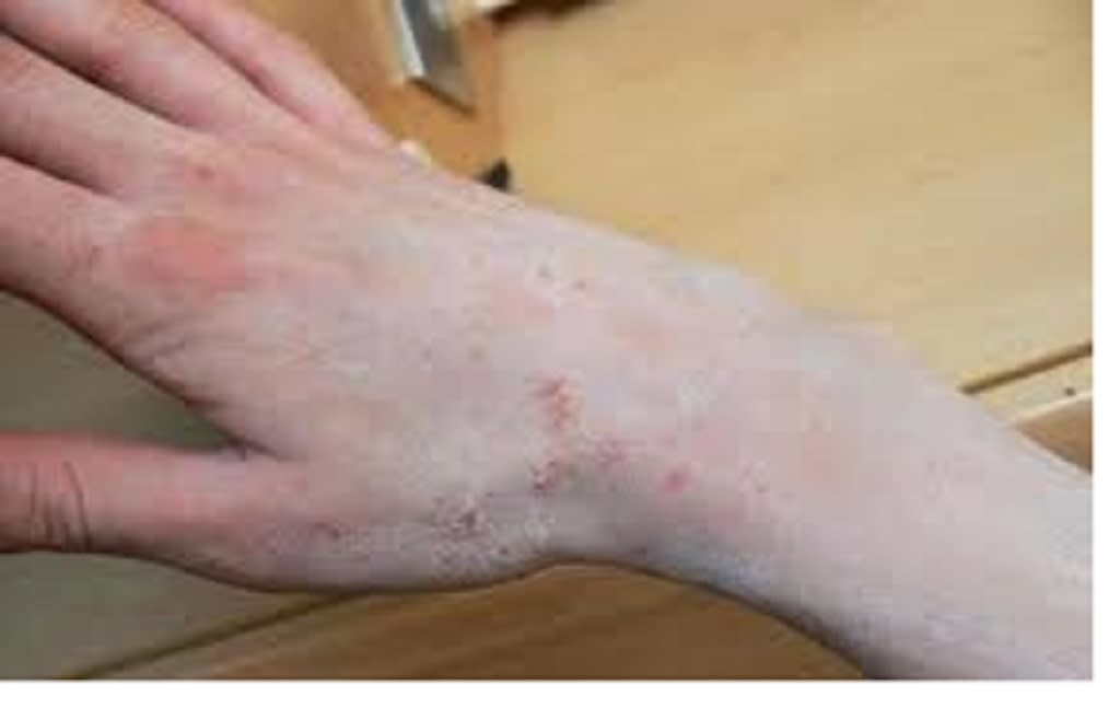 ظهور بقع بيضاء على الجلد مع حكة