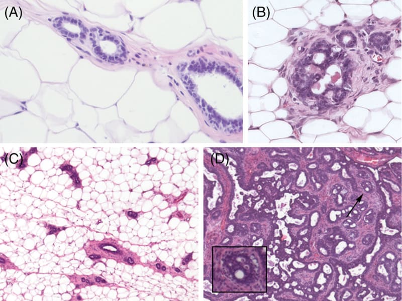 Complexity versus organization. Panel A shows
  cross-sections of normal mammary gland ducts. Panel B shows a cross-section of a ductal carcinoma in situ.