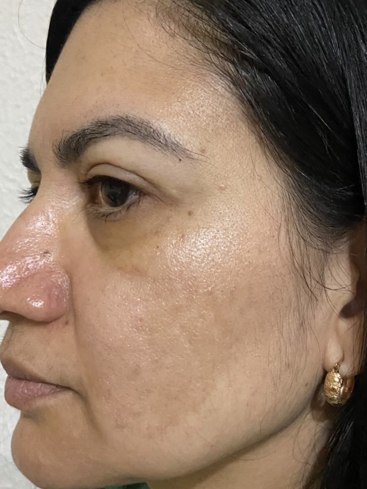 Pele em processo de renovação após sessão de laser de CO₂