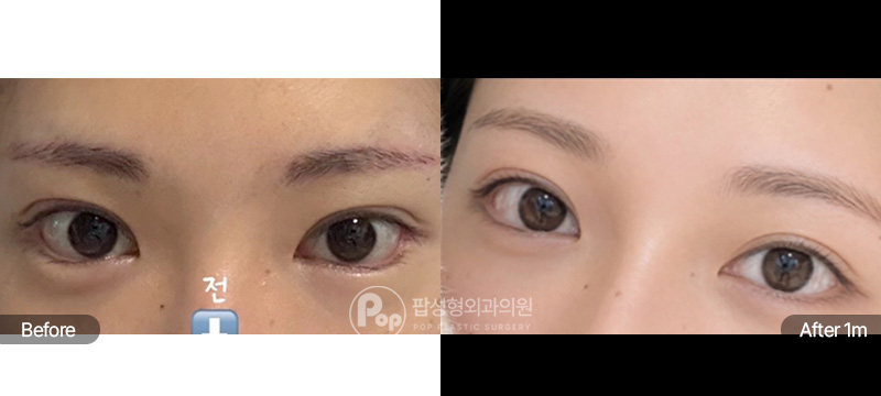 팝성형외과 앞트임 윗트임 3개월차 전후 비교
