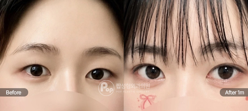 팝성형외과 자연유착 매몰 윗트임 짝눈 개선 1개월 전후