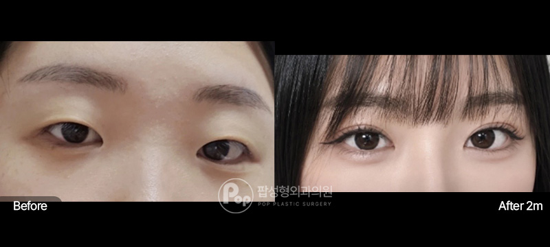팝성형외과 자연유착 매몰 앞트임 윗트임 눈매교정 2개월 전후