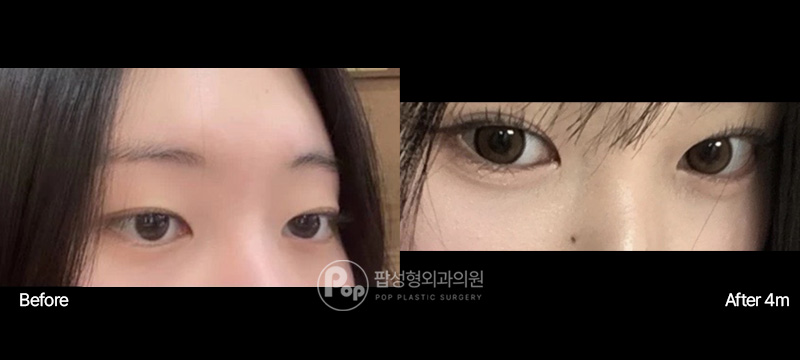 팝성형외과 첫눈 자연유착 윗트임 밑트임 인아웃라인 4개월 전후
