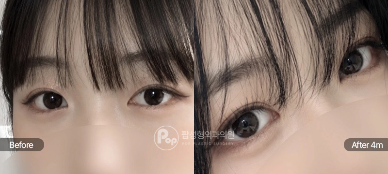 팝성형외과 자연유착 눈재수술 눈매교정 윗트임 뒤트임 2개월 전후