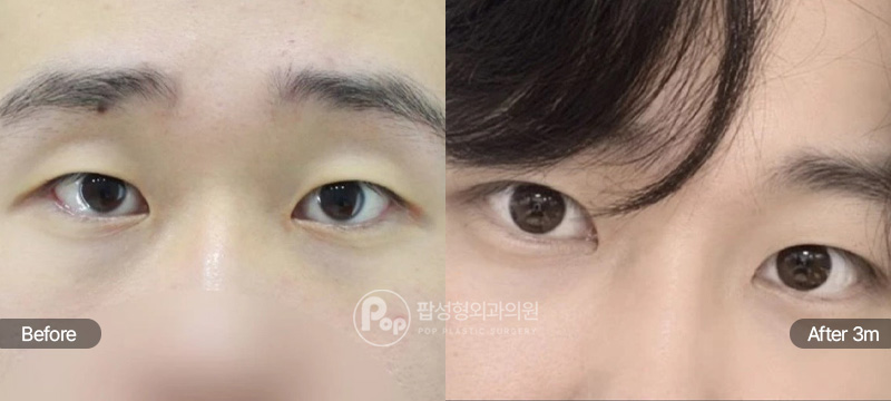 팝성형외과 첫눈 자연유착 눈매교정 앞윗트임 눈위지방제거 3개월차 전후