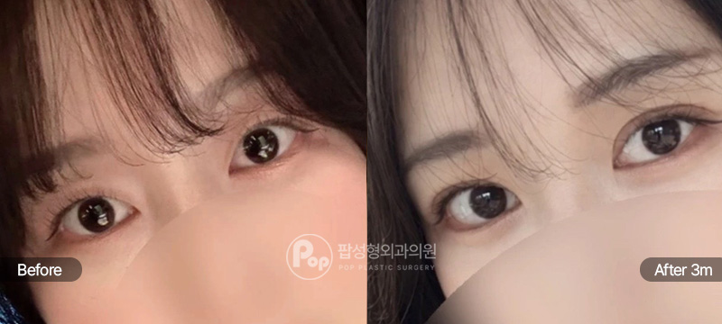 팝성형외과 첫눈성형 매몰 눈매교정 윗트임 인아웃라인 4개월차 전후 이미지