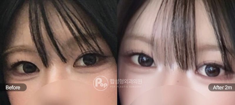 팝성형외과 눈재수술 자연유착 뒤트임 2개월차 전후 이미지