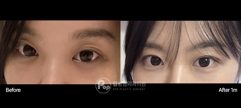 팝성형외과 쌍꺼풀 수술 매몰 눈매교정 1달차 전후 이미지