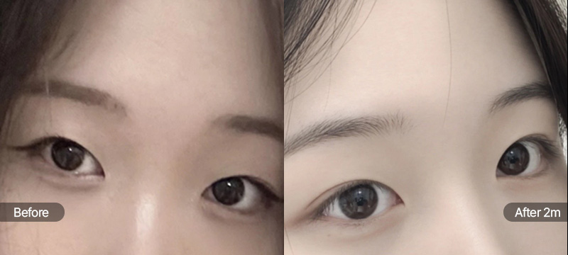 팝성형외과 자연유착 무쌍 눈매교정 2달차 전후 이미지