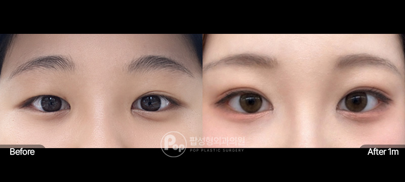 팝성형외과 눈재수술 자연유착 앞윗밑뒤트임 1달차 전후 이미지