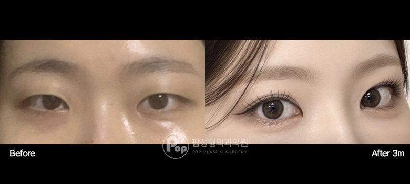 팝성형외과 눈성형 3달차 후기 팝성형외과 자연유착 눈매교정 앞윗트임 인아웃라인 3달차 전후 이미지