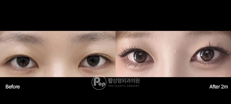 팝성형외과 짝눈 고민 눈성형 2달차 후기 팝성형외과 자연유착 눈매교정 앞윗트임 2달차 전후 이미지
