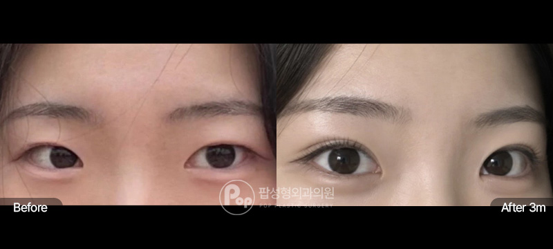 팝성형외과 눈재수술 자연유착 매몰 인아웃라인 3달차 전후 이미지