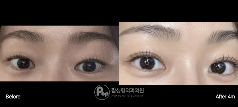 팝성형외과 첫눈성형 자연유착 눈매교정 앞트임 눈위지방제거 4달차 전후 이미지