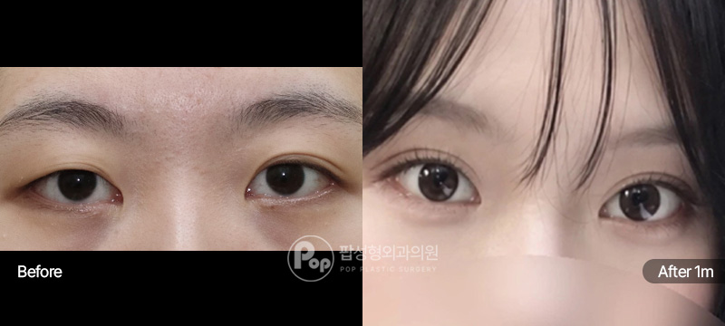 팝성형외과 눈재수술 자연유착  윗트임  1달차 전후 이미지