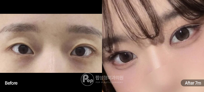 첫눈성형 자연유착·눈매교정·윗트임 7개월차 경과 이미지
