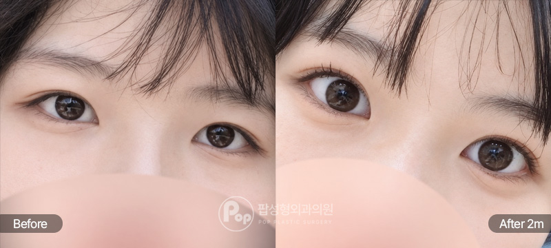 첫눈 자연유착 위앞트임 듀얼트임 2개월차 경과 이미지