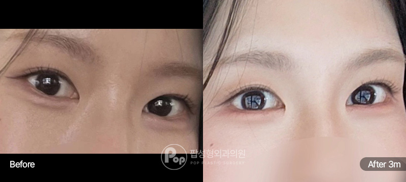 첫눈 뒤트임 밑트임 3개월차 전후 경과 이미지
