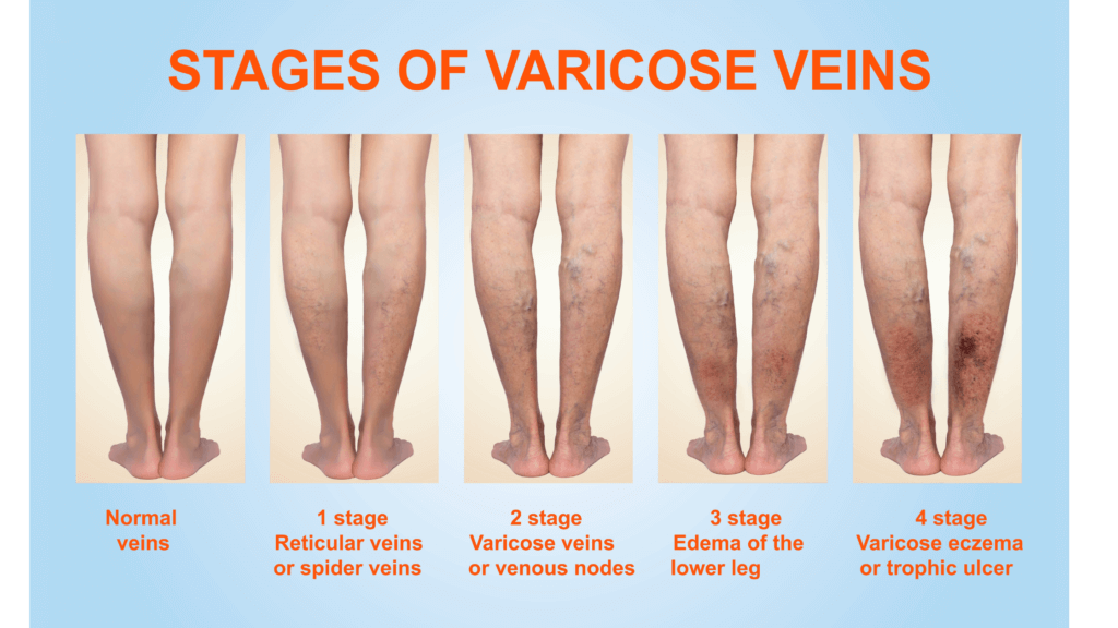 Varicose Veins Treatment In Ayurveda Man Matters