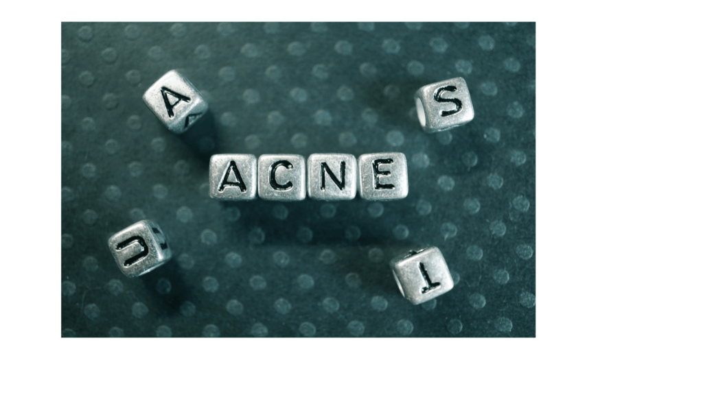 Can dandruff cause acne?