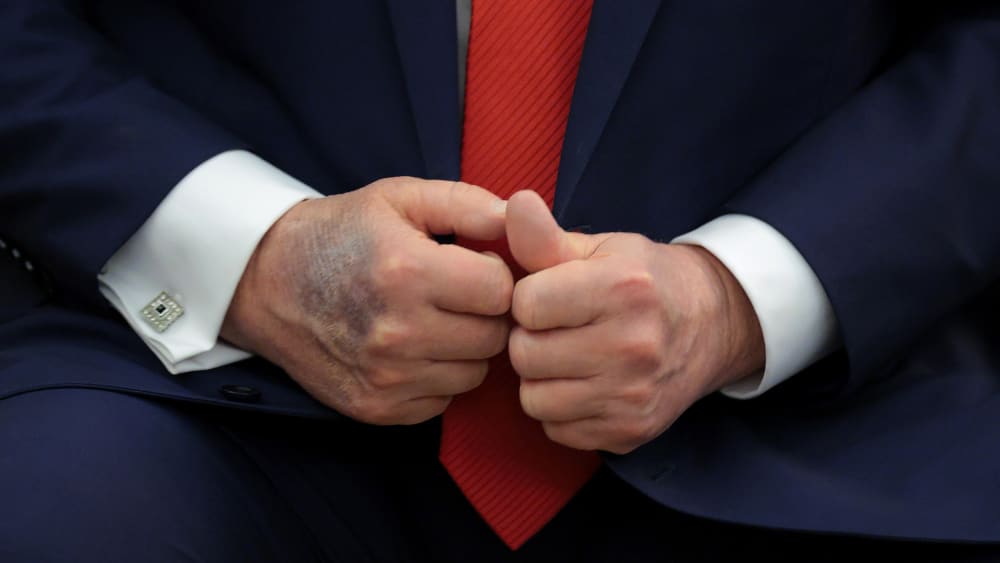 A bruise is visible on the back of Donald Trump’s right hand