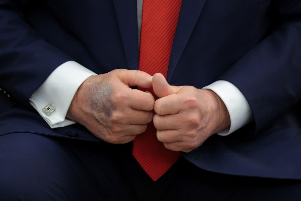 A bruise is visible on the back of Donald Trump&rsquo;s right hand