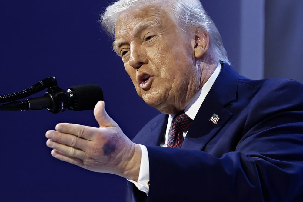 A bruise can be seen on the back of President Donald Trump's left hand during a signing ceremony for the &ldquo;Board of Peace&rdquo; on Jan. 22, 2026 in Davos, Switzerland.