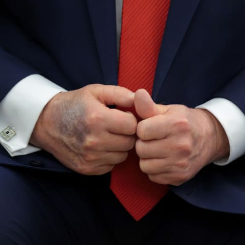 A bruise is visible on the back of Donald Trump’s right hand