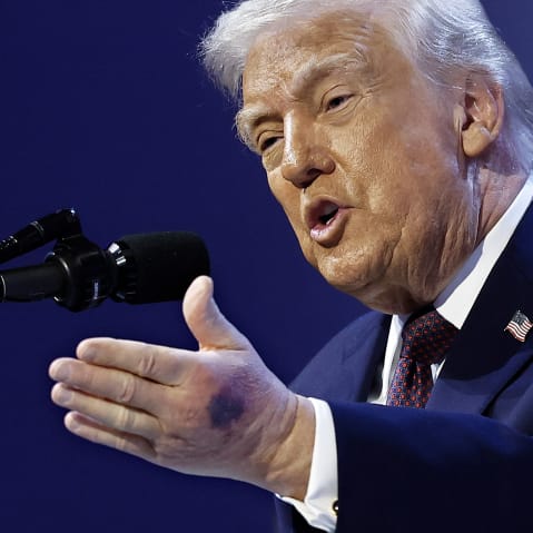 A bruise can be seen on the back of President Donald Trump's left hand during a signing ceremony for the “Board of Peace” on Jan. 22, 2026 in Davos, Switzerland.