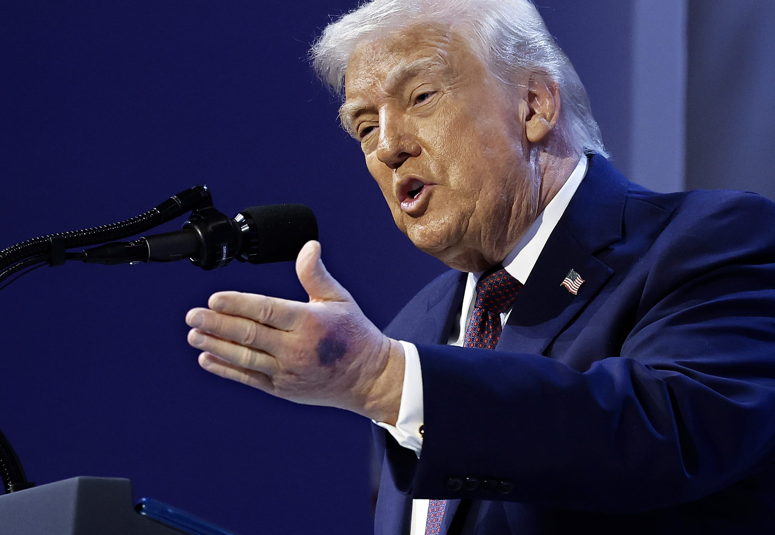 
                            New photos show deep bruising on Trump’s hand at Davos