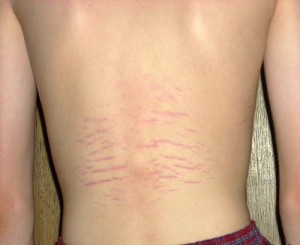 pock marks on skin pock marks on skin